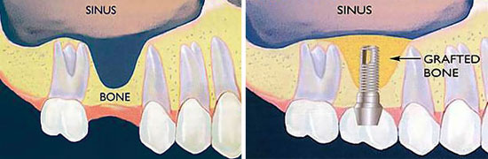 Sinus Lift - Bone Graft Treatment