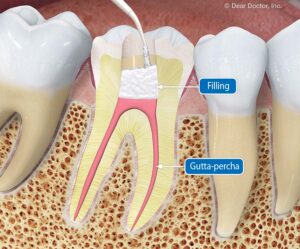 RCT-in-gurgaon | Best Dentist in Dwarka | Best Dentist In Gurgaon | Best Dental Clinic in India | Invisalign Treatment in Gurgaon | Dental Implants Treatment in Gurgaon | Root Canal Treatment in Gurgaon | Invisible Braces in Gurgaon | Denture Treatment in Gurgaon | Crowns & Bridges Treatment in Gurgaon | Kids Dentist in Gurgaon | Teeth Whitening in Gurgaon | Braces in Gurgaon | Buck Teeth Treatment in Gurgaon | My Dental Centre