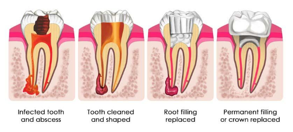 root-canal-treatment-in-gurgaon | Best Dentist in Dwarka | Best Dentist In Gurgaon | Best Dental Clinic in India | Invisalign Treatment in Gurgaon | Dental Implants Treatment in Gurgaon | Root Canal Treatment in Gurgaon | Invisible Braces in Gurgaon | Denture Treatment in Gurgaon | Crowns & Bridges Treatment in Gurgaon | Kids Dentist in Gurgaon | Teeth Whitening in Gurgaon | Braces in Gurgaon | Buck Teeth Treatment in Gurgaon | My Dental Centre