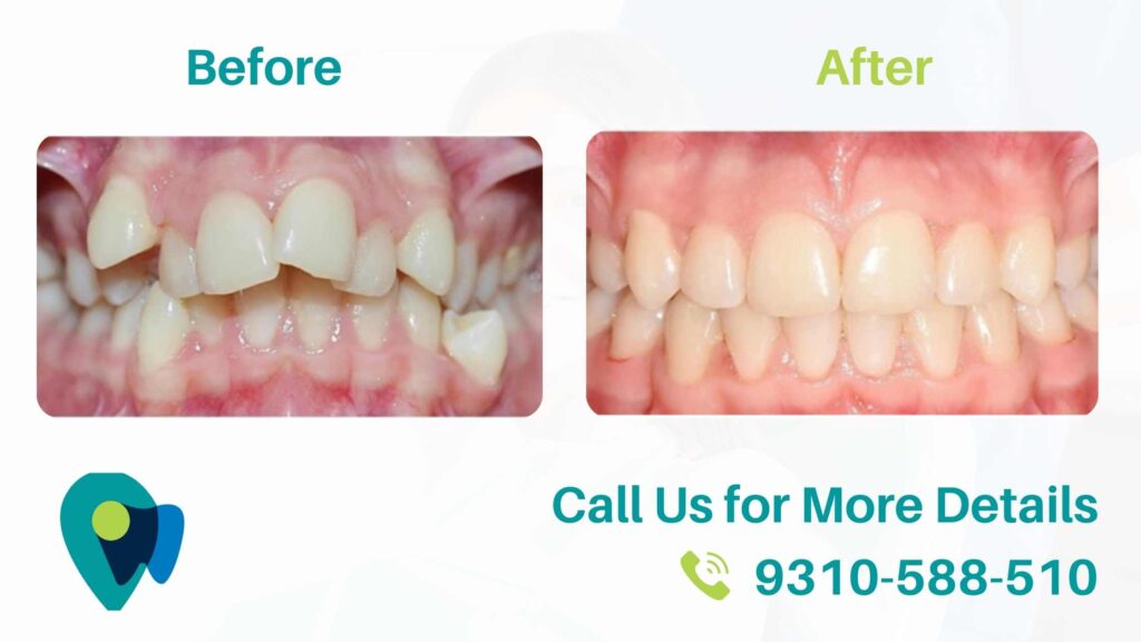 ADVANTAGES-OF-INVISIBLE-BRACES-OVER-TRADDITONAL-BRACES