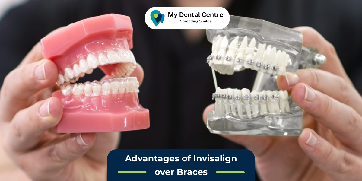 Read more about the article Advantages of Invisalign over Braces