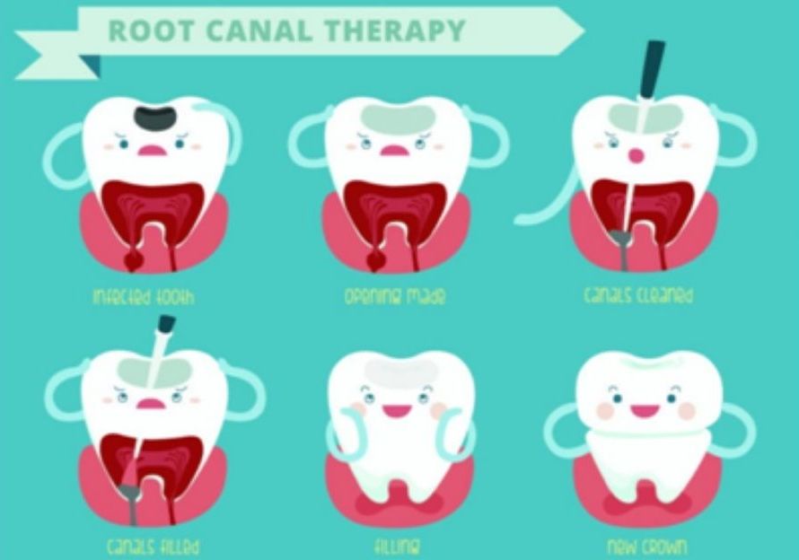 Root Canal Treatment | My Dental Centre | Best Dental Clinic in Gurgaon