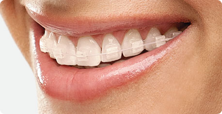 Traditional Braces Treatment near you | Best Dentist in Dwarka | Best Dentist In Gurgaon | Best Dental Clinic in India | Invisalign Treatment in Gurgaon | Dental Implants Treatment in Gurgaon | Root Canal Treatment in Gurgaon | Invisible Braces in Gurgaon | Denture Treatment in Gurgaon | Crowns & Bridges Treatment in Gurgaon | Kids Dentist in Gurgaon | Teeth Whitening in Gurgaon | Braces in Gurgaon | Buck Teeth Treatment in Gurgaon | My Dental Centre