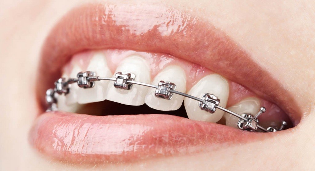 Traditional Braces Treatment near you | Best Dentist in Dwarka | Best Dentist In Gurgaon | Best Dental Clinic in India | Invisalign Treatment in Gurgaon | Dental Implants Treatment in Gurgaon | Root Canal Treatment in Gurgaon | Invisible Braces in Gurgaon | Denture Treatment in Gurgaon | Crowns & Bridges Treatment in Gurgaon | Kids Dentist in Gurgaon | Teeth Whitening in Gurgaon | Braces in Gurgaon | Buck Teeth Treatment in Gurgaon | My Dental Centre