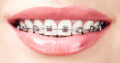 Traditional Braces Treatment near you | Best Dentist in Dwarka | Best Dentist In Gurgaon | Best Dental Clinic in India | Invisalign Treatment in Gurgaon | Dental Implants Treatment in Gurgaon | Root Canal Treatment in Gurgaon | Invisible Braces in Gurgaon | Denture Treatment in Gurgaon | Crowns & Bridges Treatment in Gurgaon | Kids Dentist in Gurgaon | Teeth Whitening in Gurgaon | Braces in Gurgaon | Buck Teeth Treatment in Gurgaon | My Dental Centre