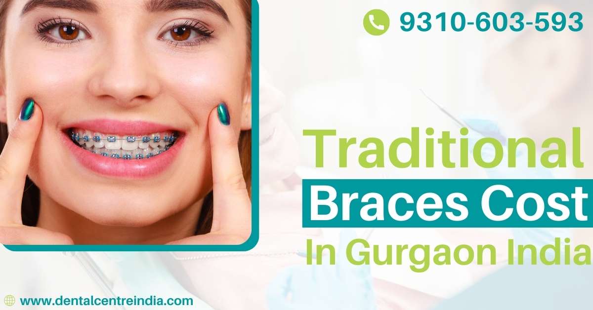 Read more about the article Traditional Braces Cost in Gurgaon