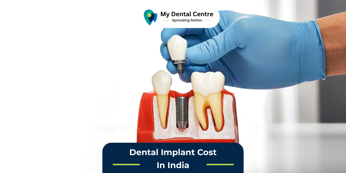 Dental Implant Cost In India My Dental Centre