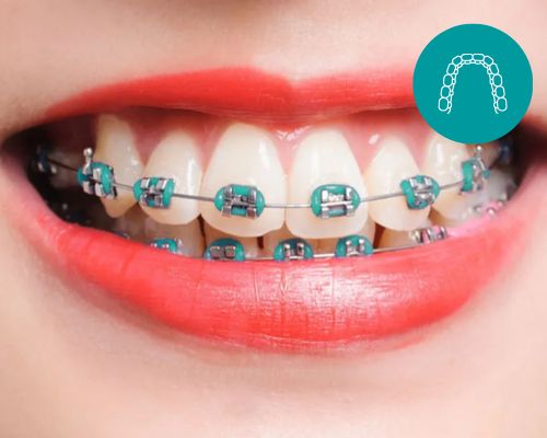 My Dental Centre Traditional Braces | Best Dentist in Dwarka | Best Dentist In Gurgaon | Best Dental Clinic in India | Invisalign Treatment in Gurgaon | Dental Implants Treatment in Gurgaon | Root Canal Treatment in Gurgaon | Invisible Braces in Gurgaon | Denture Treatment in Gurgaon | Crowns & Bridges Treatment in Gurgaon | Kids Dentist in Gurgaon | Teeth Whitening in Gurgaon | Braces in Gurgaon | Buck Teeth Treatment in Gurgaon | My Dental Centre