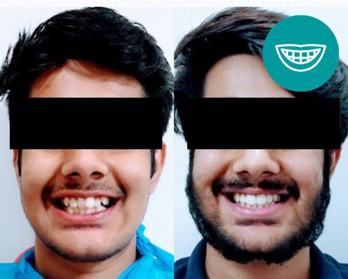 Smile Makeover | Best Dentist in Dwarka | Best Dentist In Gurgaon | Best Dental Clinic in India | Invisalign Treatment in Gurgaon | Dental Implants Treatment in Gurgaon | Root Canal Treatment in Gurgaon | Invisible Braces in Gurgaon | Denture Treatment in Gurgaon | Crowns & Bridges Treatment in Gurgaon | Kids Dentist in Gurgaon | Teeth Whitening in Gurgaon | Braces in Gurgaon | Buck Teeth Treatment in Gurgaon | My Dental Centre