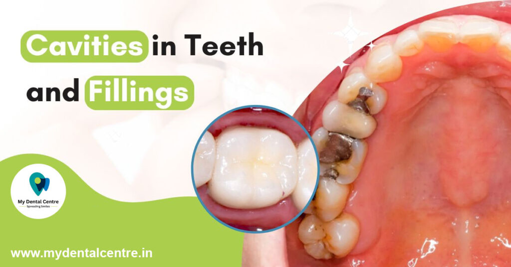 Cavities in Teeth and Fillings | Best Dentist in Dwarka | Best Dentist In Gurgaon | Best Dental Clinic in India | Invisalign Treatment in Gurgaon | Dental Implants Treatment in Gurgaon | Root Canal Treatment in Gurgaon | Invisible Braces in Gurgaon | Denture Treatment in Gurgaon | Crowns & Bridges Treatment in Gurgaon | Kids Dentist in Gurgaon | Teeth Whitening in Gurgaon | Braces in Gurgaon | Buck Teeth Treatment in Gurgaon