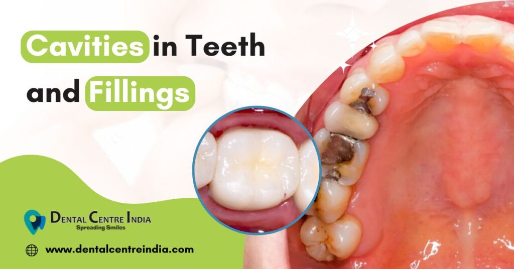 Cavities in Teeth and Fillings | Best Dentist in Dwarka | Best Dentist In Gurgaon | Best Dental Clinic in India | Invisalign Treatment in Gurgaon | Dental Implants Treatment in Gurgaon | Root Canal Treatment in Gurgaon | Invisible Braces in Gurgaon | Denture Treatment in Gurgaon | Crowns & Bridges Treatment in Gurgaon | Kids Dentist in Gurgaon | Teeth Whitening in Gurgaon | Braces in Gurgaon | Buck Teeth Treatment in Gurgaon