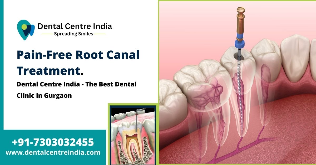 Read more about the article Pain-Free Root Canal Treatment | My Dental Centre | The Best Dental Clinic in Gurgaon