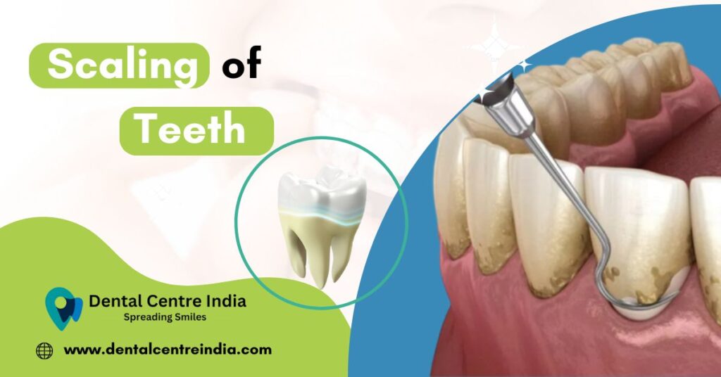 Scaling Of Teeth | My Dental Centre | Best Dentist in Dwarka | Best Dentist In Gurgaon | Best Dental Clinic in India | Invisalign Treatment in Gurgaon | Dental Implants Treatment in Gurgaon | Root Canal Treatment in Gurgaon | Invisible Braces in Gurgaon | Denture Treatment in Gurgaon | Crowns & Bridges Treatment in Gurgaon | Kids Dentist in Gurgaon | Teeth Whitening in Gurgaon | Braces in Gurgaon | Buck Teeth Treatment in Gurgaon