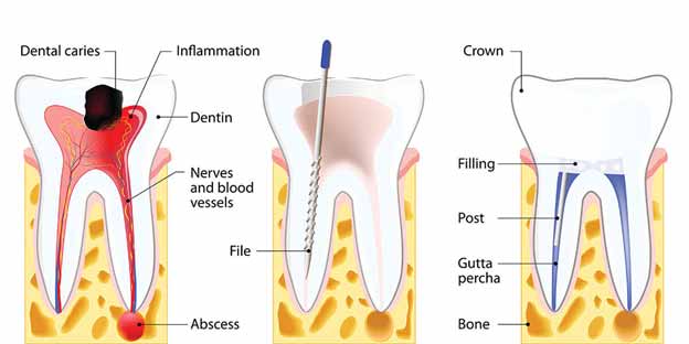 Pain-Free Root Canal Treatment | My Dental Centre | Best Dentist in Dwarka | Best Dentist In Gurgaon | Best Dental Clinic in India | Invisalign Treatment in Gurgaon | Dental Implants Treatment in Gurgaon | Root Canal Treatment in Gurgaon | Invisible Braces in Gurgaon | Denture Treatment in Gurgaon | Crowns & Bridges Treatment in Gurgaon | Kids Dentist in Gurgaon | Teeth Whitening in Gurgaon | Braces in Gurgaon | Buck Teeth Treatment in Gurgaon