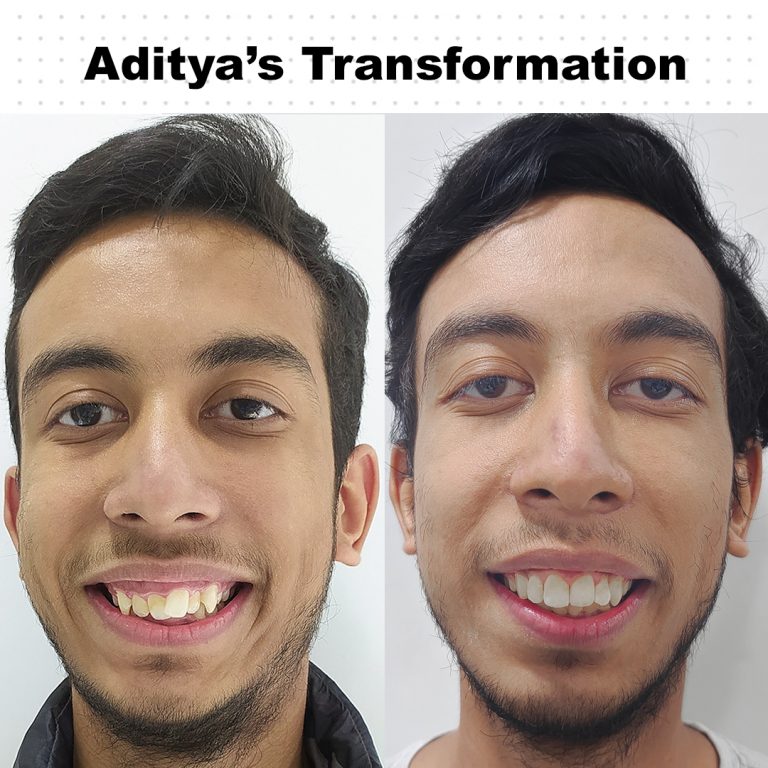 Best Dentist in Dwarka | Best Dentist In Gurgaon | Best Dental Clinic in India | Invisalign Treatment in Gurgaon | Dental Implants Treatment in Gurgaon | Root Canal Treatment in Gurgaon | Invisible Braces in Gurgaon | Denture Treatment in Gurgaon | Crowns & Bridges Treatment in Gurgaon | Kids Dentist in Gurgaon | Teeth Whitening in Gurgaon | Braces in Gurgaon | Buck Teeth Treatment in Gurgaon