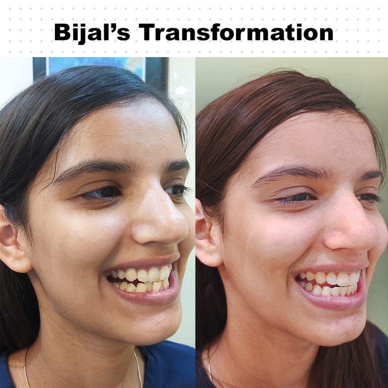 Best Dentist in Dwarka | Best Dentist In Gurgaon | Best Dental Clinic in India | Invisalign Treatment in Gurgaon | Dental Implants Treatment in Gurgaon | Root Canal Treatment in Gurgaon | Invisible Braces in Gurgaon | Denture Treatment in Gurgaon | Crowns & Bridges Treatment in Gurgaon | Kids Dentist in Gurgaon | Teeth Whitening in Gurgaon | Braces in Gurgaon | Buck Teeth Treatment in Gurgaon