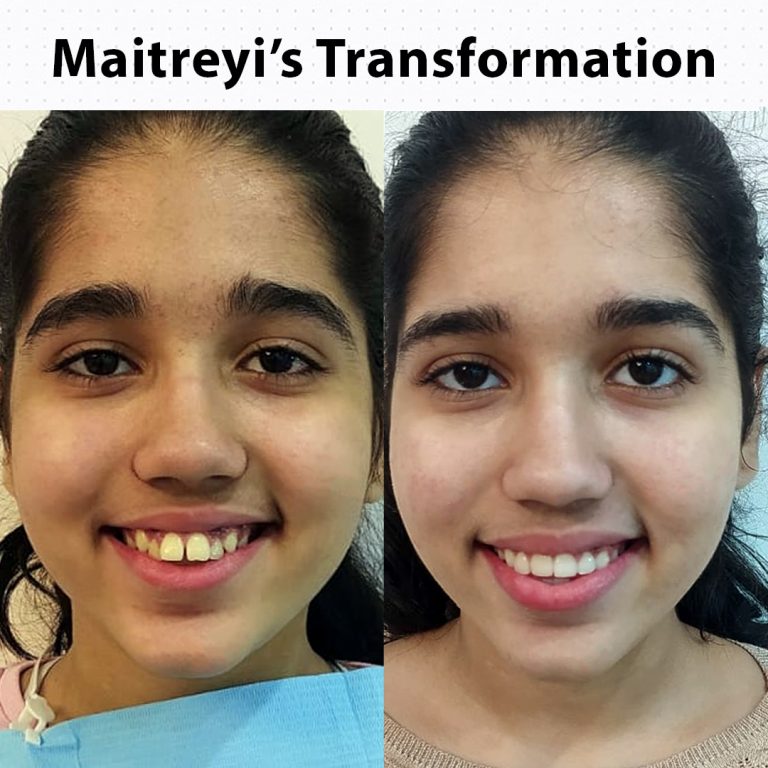 Best Dentist in Dwarka | Best Dentist In Gurgaon | Best Dental Clinic in India | Invisalign Treatment in Gurgaon | Dental Implants Treatment in Gurgaon | Root Canal Treatment in Gurgaon | Invisible Braces in Gurgaon | Denture Treatment in Gurgaon | Crowns & Bridges Treatment in Gurgaon | Kids Dentist in Gurgaon | Teeth Whitening in Gurgaon | Braces in Gurgaon | Buck Teeth Treatment in Gurgaon