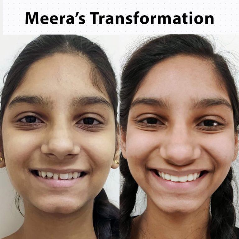 Best Dentist in Dwarka | Best Dentist In Gurgaon | Best Dental Clinic in India | Invisalign Treatment in Gurgaon | Dental Implants Treatment in Gurgaon | Root Canal Treatment in Gurgaon | Invisible Braces in Gurgaon | Denture Treatment in Gurgaon | Crowns & Bridges Treatment in Gurgaon | Kids Dentist in Gurgaon | Teeth Whitening in Gurgaon | Braces in Gurgaon | Buck Teeth Treatment in Gurgaon
