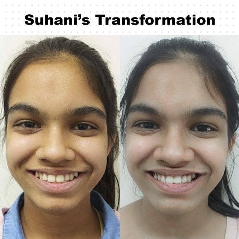 Best Dentist in Dwarka | Best Dentist In Gurgaon | Best Dental Clinic in India | Invisalign Treatment in Gurgaon | Dental Implants Treatment in Gurgaon | Root Canal Treatment in Gurgaon | Invisible Braces in Gurgaon | Denture Treatment in Gurgaon | Crowns & Bridges Treatment in Gurgaon | Kids Dentist in Gurgaon | Teeth Whitening in Gurgaon | Braces in Gurgaon | Buck Teeth Treatment in Gurgaon