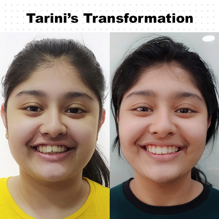 Best Dentist in Dwarka | Best Dentist In Gurgaon | Best Dental Clinic in India | Invisalign Treatment in Gurgaon | Dental Implants Treatment in Gurgaon | Root Canal Treatment in Gurgaon | Invisible Braces in Gurgaon | Denture Treatment in Gurgaon | Crowns & Bridges Treatment in Gurgaon | Kids Dentist in Gurgaon | Teeth Whitening in Gurgaon | Braces in Gurgaon | Buck Teeth Treatment in Gurgaon