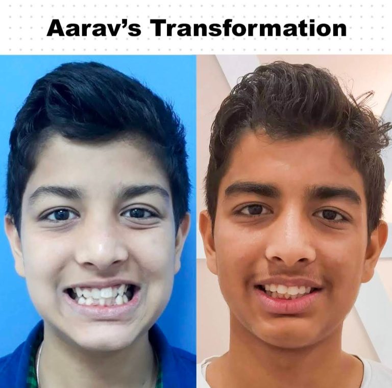 Best Dentist in Dwarka | Best Dentist In Gurgaon | Best Dental Clinic in India | Invisalign Treatment in Gurgaon | Dental Implants Treatment in Gurgaon | Root Canal Treatment in Gurgaon | Invisible Braces in Gurgaon | Denture Treatment in Gurgaon | Crowns & Bridges Treatment in Gurgaon | Kids Dentist in Gurgaon | Teeth Whitening in Gurgaon | Braces in Gurgaon | Buck Teeth Treatment in Gurgaon