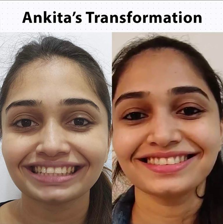 Best Dentist in Dwarka | Best Dentist In Gurgaon | Best Dental Clinic in India | Invisalign Treatment in Gurgaon | Dental Implants Treatment in Gurgaon | Root Canal Treatment in Gurgaon | Invisible Braces in Gurgaon | Denture Treatment in Gurgaon | Crowns & Bridges Treatment in Gurgaon | Kids Dentist in Gurgaon | Teeth Whitening in Gurgaon | Braces in Gurgaon | Buck Teeth Treatment in Gurgaon | My Dental Centre