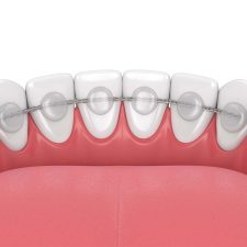 Retainers for Buck Teeth | Buck Teeth Treatment | Dentist in Dwarka | Dentist in Gurgaon | Best dental clinic in India | Invisible Braces In Gurgaon | Dental Implants in Gurgaon | My Dental Centre