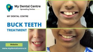 Read more about the article Buck Teeth Treatment – Transform Your Smile with My Dental Centre