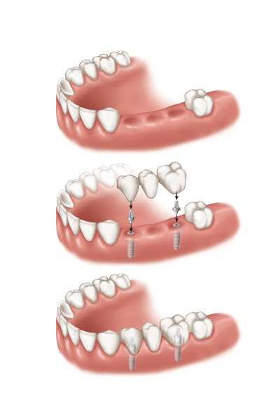 Best Dentist in Dwarka | Best Dentist In Gurgaon | Best Dental Clinic in India | Invisalign Treatment in Gurgaon | Dental Implants Treatment in Gurgaon | Root Canal Treatment in Gurgaon | Invisible Braces in Gurgaon | Denture Treatment in Gurgaon | Crowns & Bridges Treatment in Gurgaon | Kids Dentist in Gurgaon | Teeth Whitening in Gurgaon | Braces in Gurgaon | Buck Teeth Treatment in Gurgaon | My Dental Centre