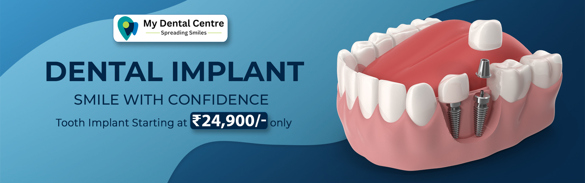 My Dental Centre Tooth Implant Srarting at 24900