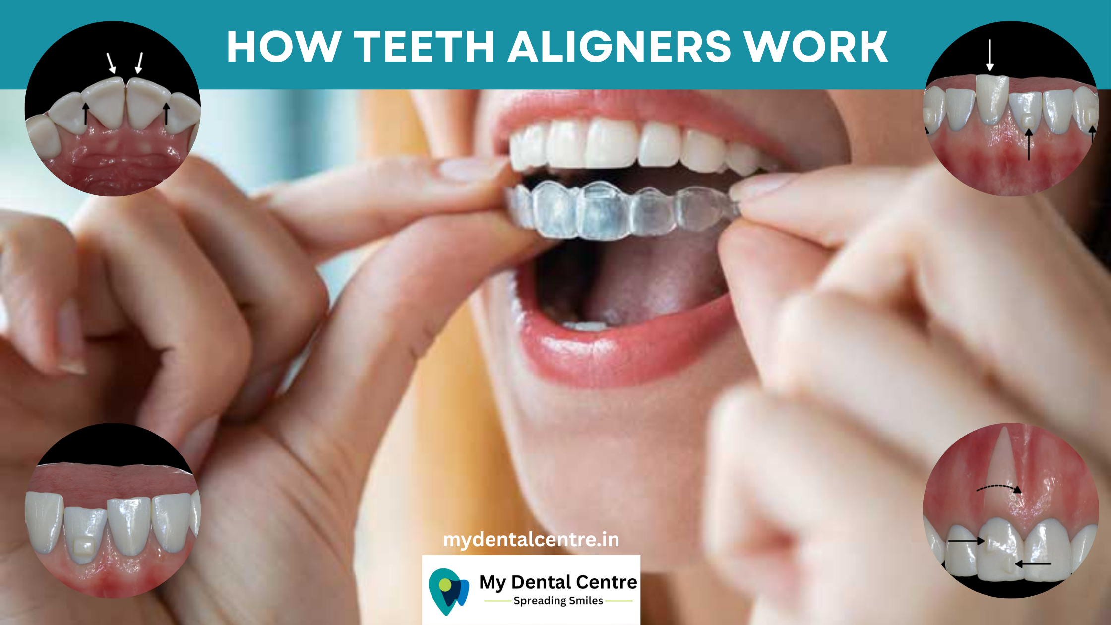 Read more about the article How teeth aligners work