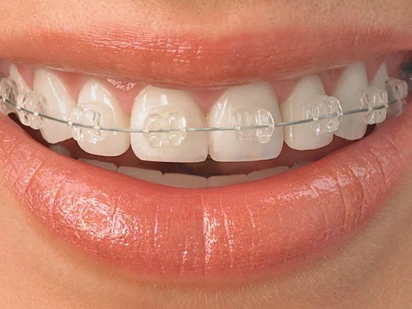 Traditional Braces Treatment near you | Best Dentist in Dwarka | Best Dentist In Gurgaon | Best Dental Clinic in India | Invisalign Treatment in Gurgaon | Dental Implants Treatment in Gurgaon | Root Canal Treatment in Gurgaon | Invisible Braces in Gurgaon | Denture Treatment in Gurgaon | Crowns & Bridges Treatment in Gurgaon | Kids Dentist in Gurgaon | Teeth Whitening in Gurgaon | Braces in Gurgaon | Buck Teeth Treatment in Gurgaon | My Dental Centre
