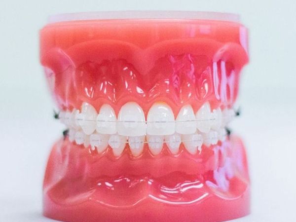 Traditional Braces Treatment near you | Best Dentist in Dwarka | Best Dentist In Gurgaon | Best Dental Clinic in India | Invisalign Treatment in Gurgaon | Dental Implants Treatment in Gurgaon | Root Canal Treatment in Gurgaon | Invisible Braces in Gurgaon | Denture Treatment in Gurgaon | Crowns & Bridges Treatment in Gurgaon | Kids Dentist in Gurgaon | Teeth Whitening in Gurgaon | Braces in Gurgaon | Buck Teeth Treatment in Gurgaon | My Dental Centre