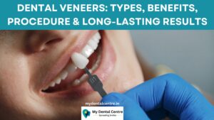 Read more about the article Dental Veneers: Types, Benefits, Procedure & Long-Lasting Results