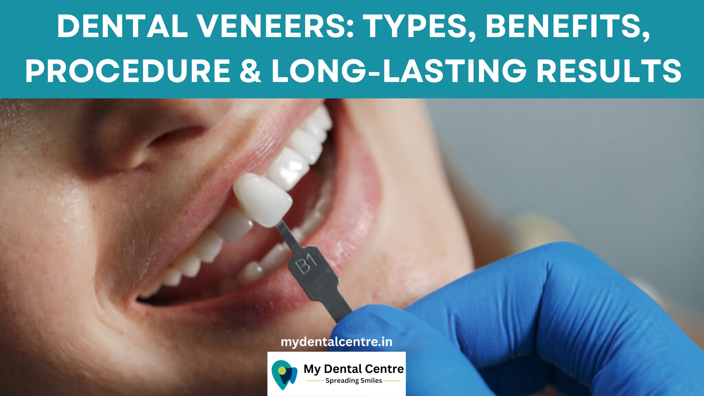 Read more about the article Dental Veneers: Types, Benefits, Procedure & Long-Lasting Results