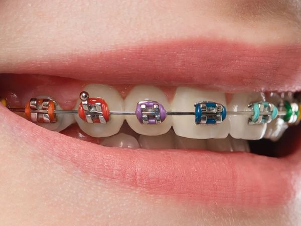 Metal Braces in India | Traditional Braces Treatment near you | Best Dentist in Dwarka | Best Dentist In Gurgaon | Best Dental Clinic in India | Invisalign Treatment in Gurgaon | Dental Implants Treatment in Gurgaon | Root Canal Treatment in Gurgaon | Invisible Braces in Gurgaon | Denture Treatment in Gurgaon | Crowns & Bridges Treatment in Gurgaon | Kids Dentist in Gurgaon | Teeth Whitening in Gurgaon | Braces in Gurgaon | Buck Teeth Treatment in Gurgaon | My Dental Centre