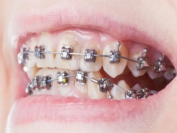 Traditional Braces Treatment near you | Best Dentist in Dwarka | Best Dentist In Gurgaon | Best Dental Clinic in India | Invisalign Treatment in Gurgaon | Dental Implants Treatment in Gurgaon | Root Canal Treatment in Gurgaon | Invisible Braces in Gurgaon | Denture Treatment in Gurgaon | Crowns & Bridges Treatment in Gurgaon | Kids Dentist in Gurgaon | Teeth Whitening in Gurgaon | Braces in Gurgaon | Buck Teeth Treatment in Gurgaon | My Dental Centre