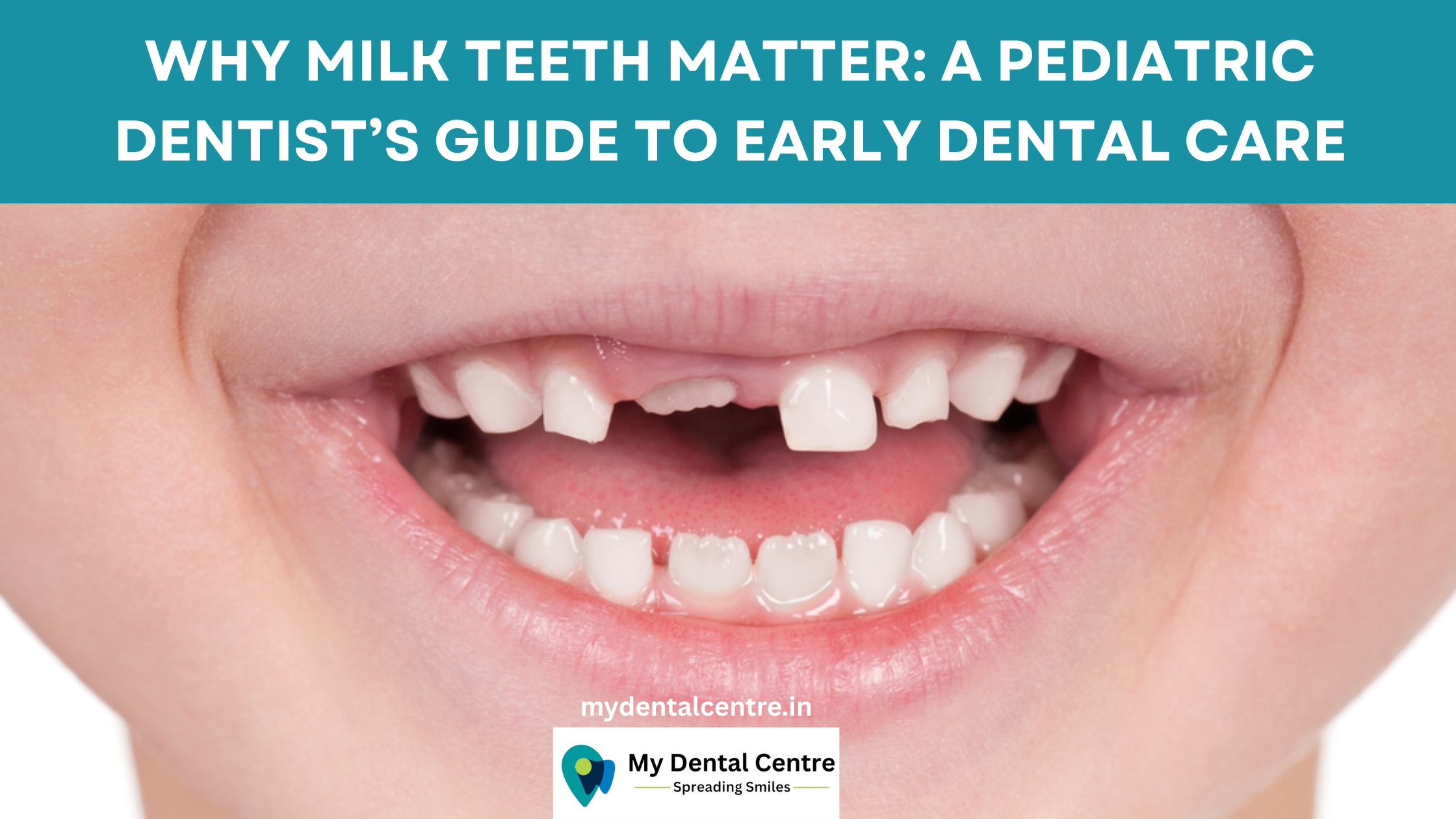 Read more about the article Why Milk Teeth Matter: A Pediatric Dentist’s Guide to Early Dental Care