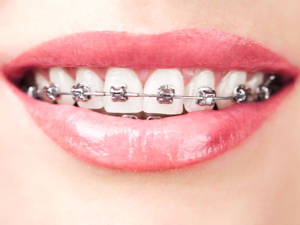 Traditional Braces Treatment near you | Best Dentist in Dwarka | Best Dentist In Gurgaon | Best Dental Clinic in India | Invisalign Treatment in Gurgaon | Dental Implants Treatment in Gurgaon | Root Canal Treatment in Gurgaon | Invisible Braces in Gurgaon | Denture Treatment in Gurgaon | Crowns & Bridges Treatment in Gurgaon | Kids Dentist in Gurgaon | Teeth Whitening in Gurgaon | Braces in Gurgaon | Buck Teeth Treatment in Gurgaon | My Dental Centre