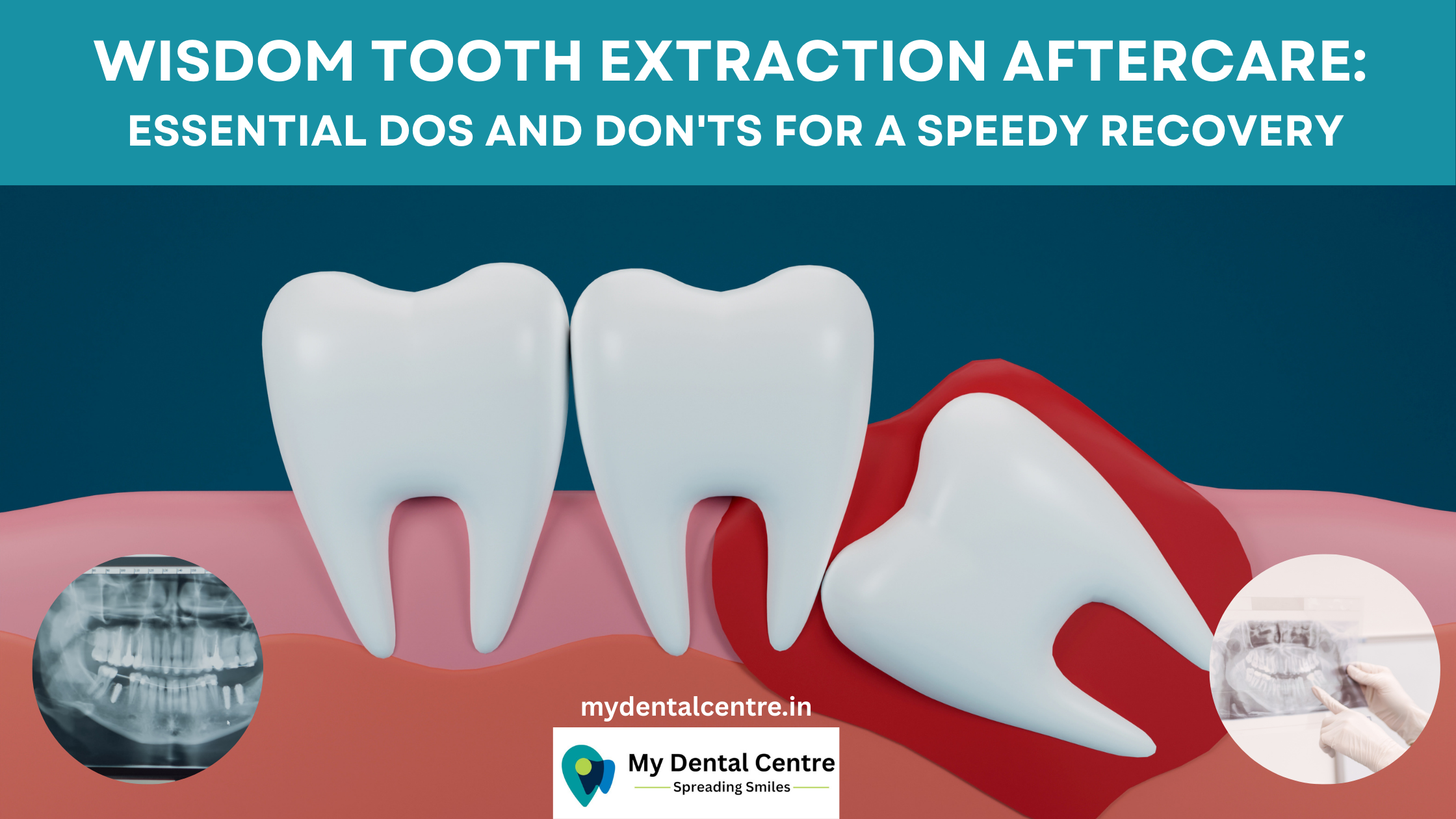 Read more about the article Best options to replace missing teeth