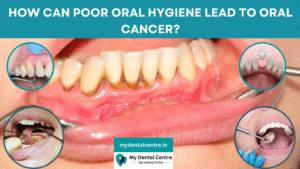 Read more about the article How poor oral hygiene can lead to oral cancer