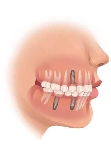 Sinus Lift - Bone Graft Treatment In India