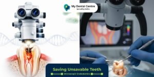 Saving unsavable teeth - Microscopic Endodontics