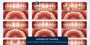Invisalign for Crowding: Fix Crooked & Crowded Teeth Without Metal Braces