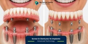 Screw-in Dentures Vs Implants | Best Dental Clinic in Gurugram | Best Dentist in Gurugram | Best Dental Clinic in Dwarka | Best Dentist in Dwarka | Dentist Near Me | Dental Clinic Near Me | My Dental Centre
