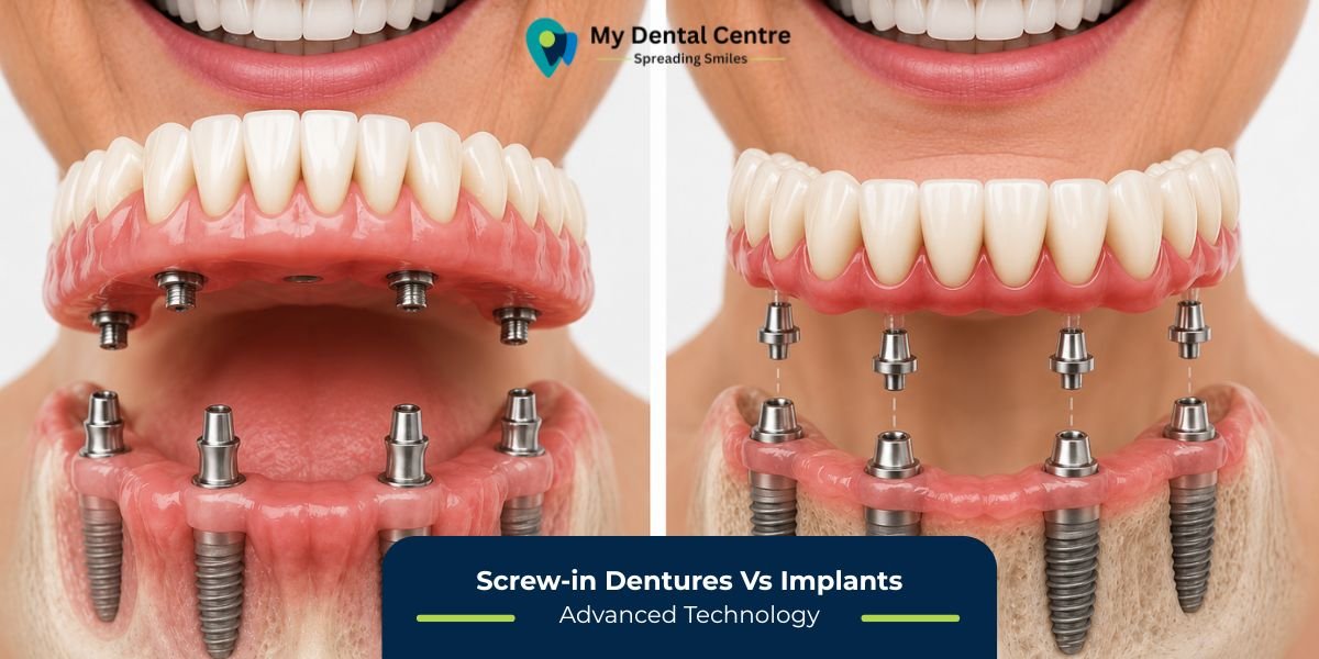 Screw-in Dentures Vs Implants | Best Dental Clinic in Gurugram | Best Dentist in Gurugram | Best Dental Clinic in Dwarka | Best Dentist in Dwarka | Dentist Near Me | Dental Clinic Near Me | My Dental Centre