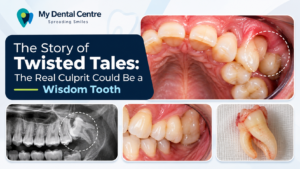 Story of Twisted Tails: The Real Culprit Could Be Your Wisdom Tooth! | Dentist in Gurgaon |Dental clinic in Gurgaon