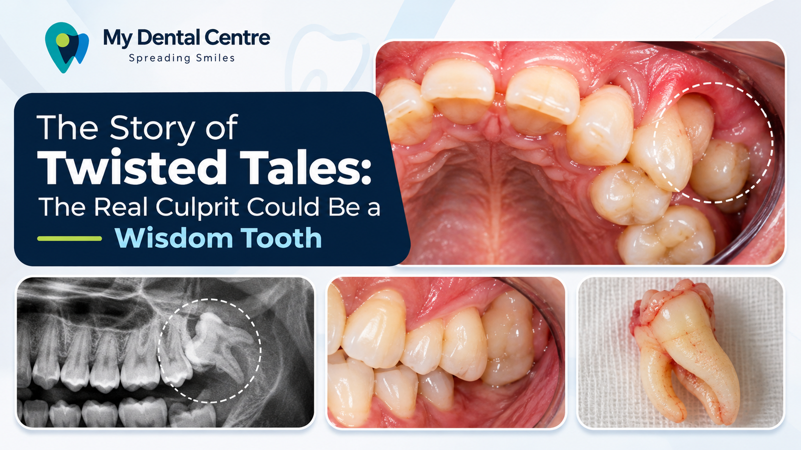 Story of Twisted Tails: The Real Culprit Could Be Your Wisdom Tooth! | Dentist in Gurgaon |Dental clinic in Gurgaon